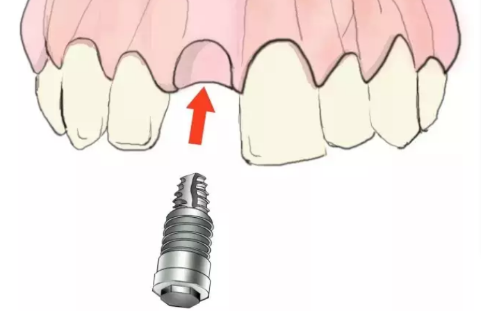 深圳牙科種植牙，牙齒缺一顆，不補也沒關係嗎？