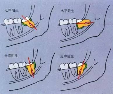 深圳拔智齒貴嗎？拔智齒會不會很痛？