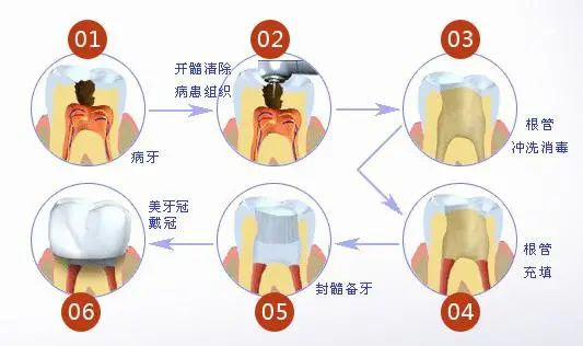 深圳做根管治療的一些常見問題你知道嗎？