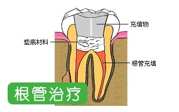 做完根管治療後牙痛是什麼原因？有深圳專家解答嗎？ 