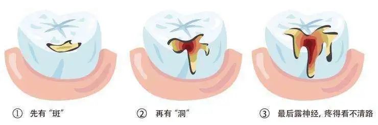 在深圳福田的牙科把齲齒補好了需要注意什麼？