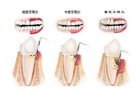 深圳牙齒矯正|患上牙周炎的還可以牙齒矯正嗎？