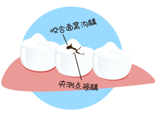 深圳牙醫科普：單側咀噍會有咩危害？ 