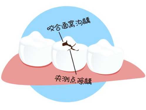 深圳補牙推介，門牙牙縫大怎麼修復好？