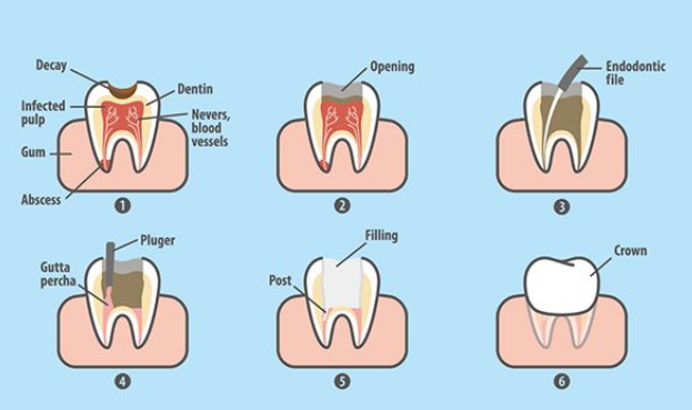 深圳牙醫解答：咩情況才考慮磨牙齒做牙冠呢?