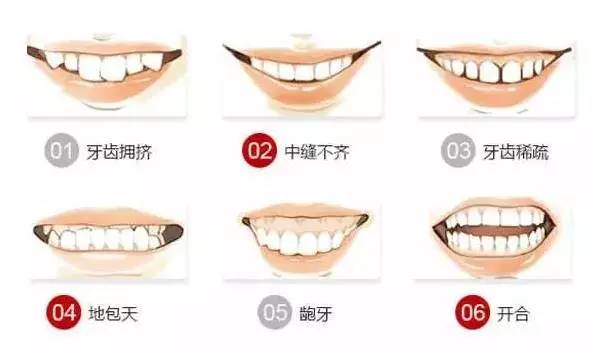 深圳看牙|牙齒錯顎畸形的危害性有哪些？