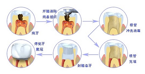 根管治療用什麼封閉根管？深圳牙科根管治療！