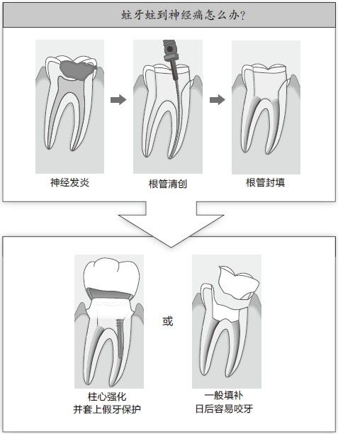 深圳牙科看蛀牙蛀到神經痛，根管治療可以嗎？