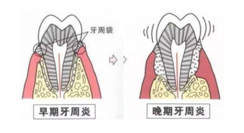 牙周病有什麽特點？深圳牙科醫生這樣建議