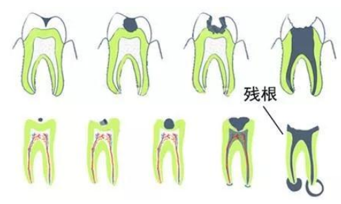 深圳牙科拔牙，老年人殘根、殘冠的治療以及保留的意義