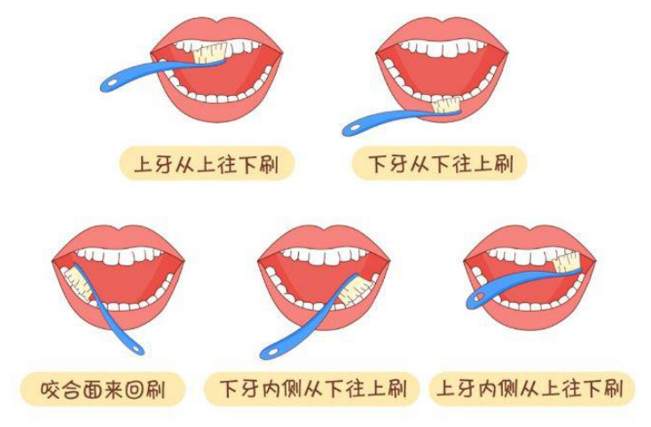 深圳種牙預防，預防掉牙的方法有哪些？