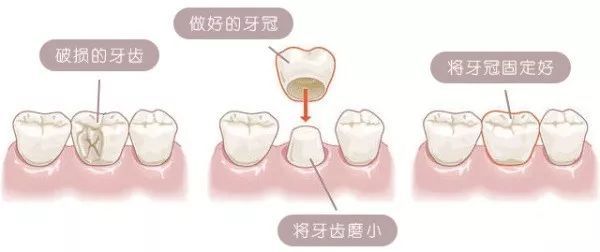 深圳牙科點樣選擇牙冠更好？