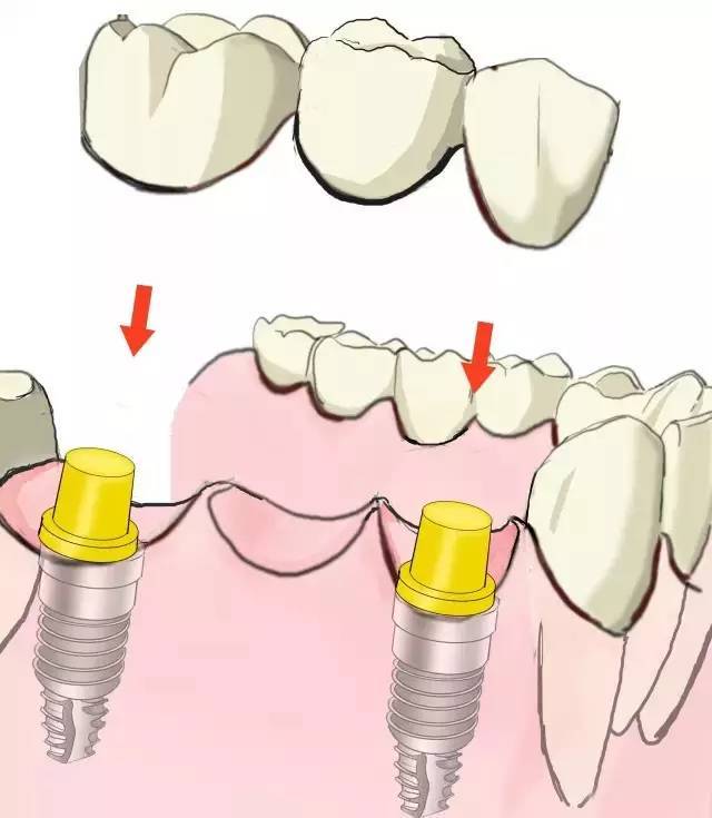 深圳種牙醫院推介
