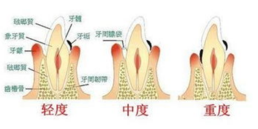 深圳牙醫表示，以下三種牙齒松動嘅情況要甘治療？