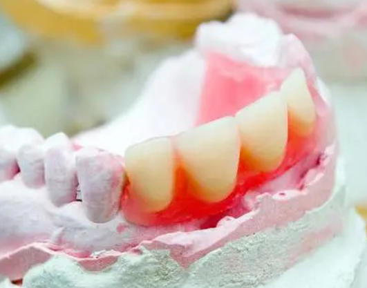 深圳全瓷牙套的最新收費價格？全瓷牙套做單冠還是連冠好？