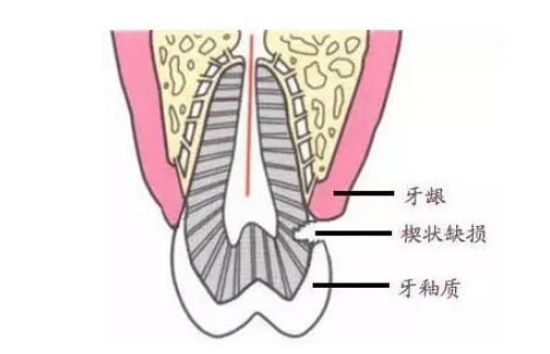 深圳牙醫解答：牙齒楔狀缺損系點樣操作嘅？ 