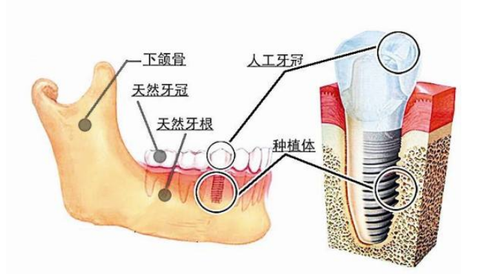 深圳種植牙推介，種植牙掂嘅關鍵因素系乜？ 