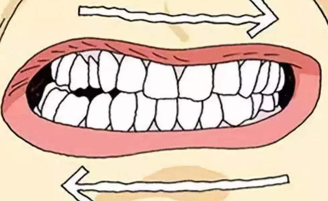 深圳牙醫科普：磨牙會唔會磨損牙齒呢？ 