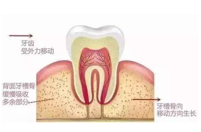 深圳牙醫科普：咩原因會導致牙槽骨被吸收？深圳種牙價格