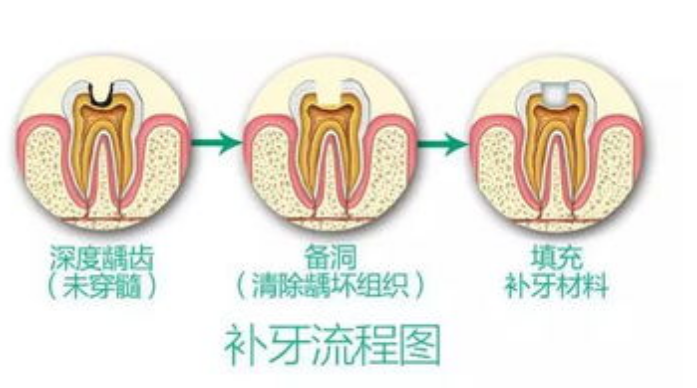 深圳牙醫科普：點樣可以緩解補牙後嘅疼痛呢？