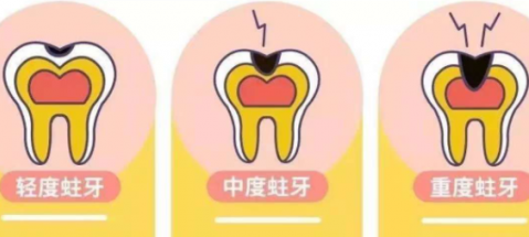 深圳牙科醫師科普，點解補過嘅牙齒還會蛀牙？ 