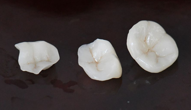 深圳牙科推介？嵌體同牙套邊個好？