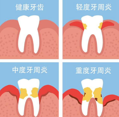 深圳牙周病收費？牙周病引起嘅牙齒鬆動係否需要剝牙？