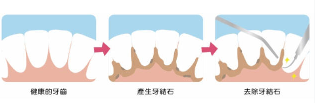 深圳牙科邊度好？點解醫生建議每年至少洗1-2次牙？