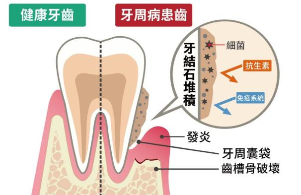 深圳牙科邊間好？點解有牙周病？點樣預防牙周病？