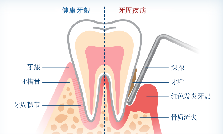 深圳牙科邊間好？牙周病治療後會有後遺症？