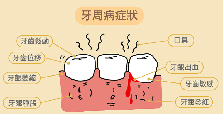 深圳牙醫科普：6個症狀告訴你患有牙周病