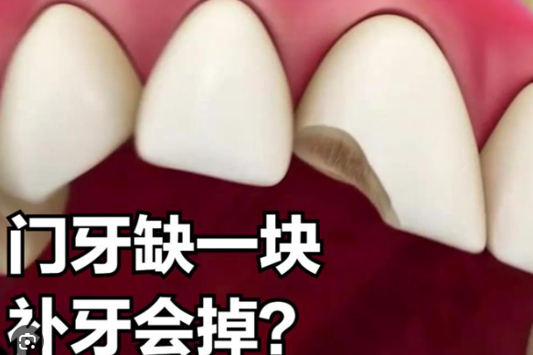 深圳維港口腔邊間好？門牙缺損點樣修復呢？