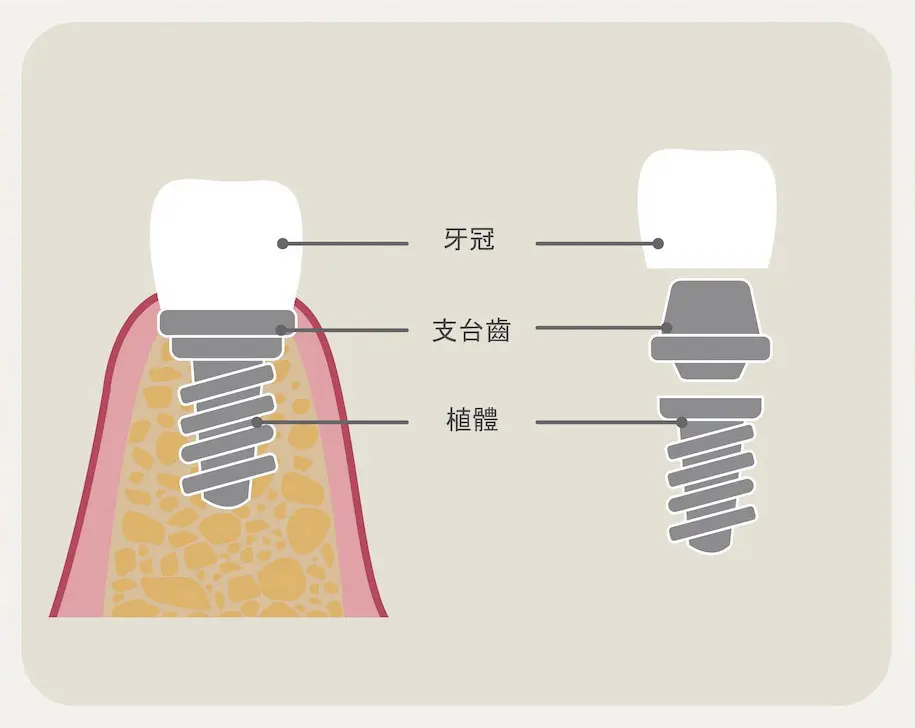 種植牙嘅牙冠受損可以更換嗎？深圳種植牙幾錢？