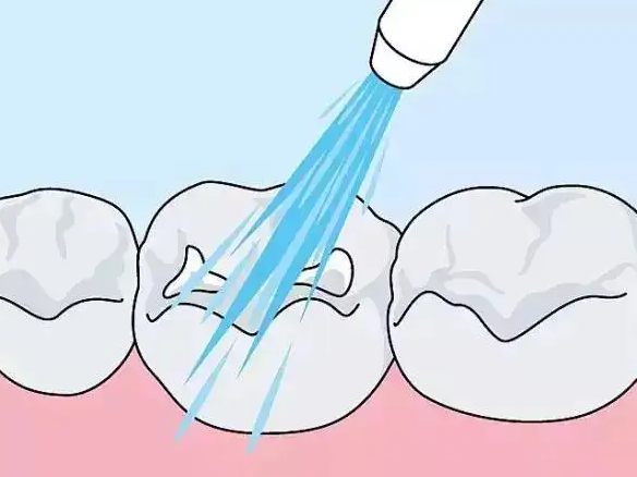 深圳羅湖口岸洗牙邊間好？深圳洗牙幾錢？