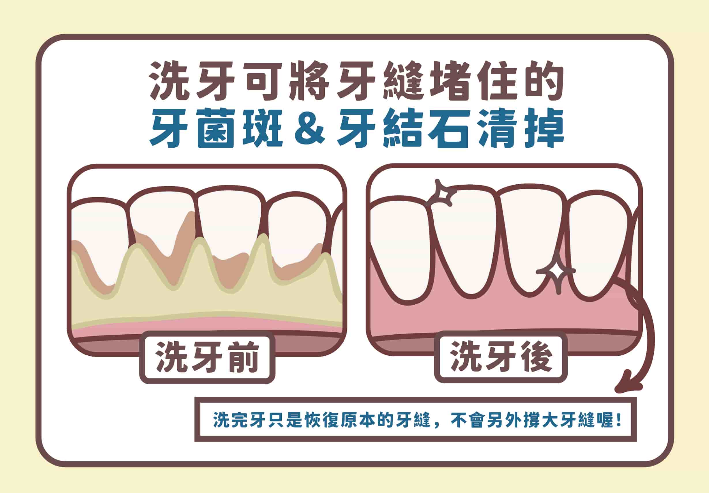 維港口腔科普：點解春節後建議要洗牙？