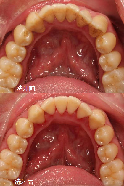 維港口腔洗牙前後對比