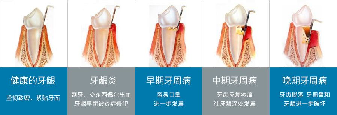 牙周病發展歷程
