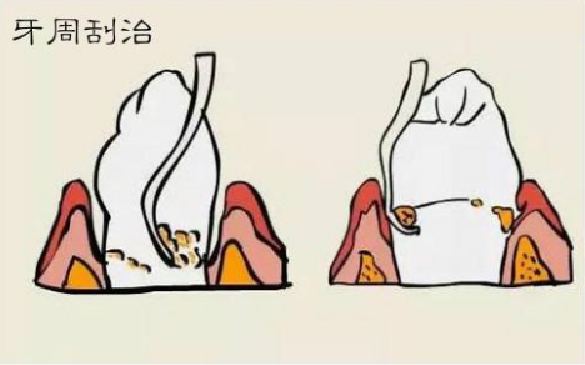 深圳深度洗牙