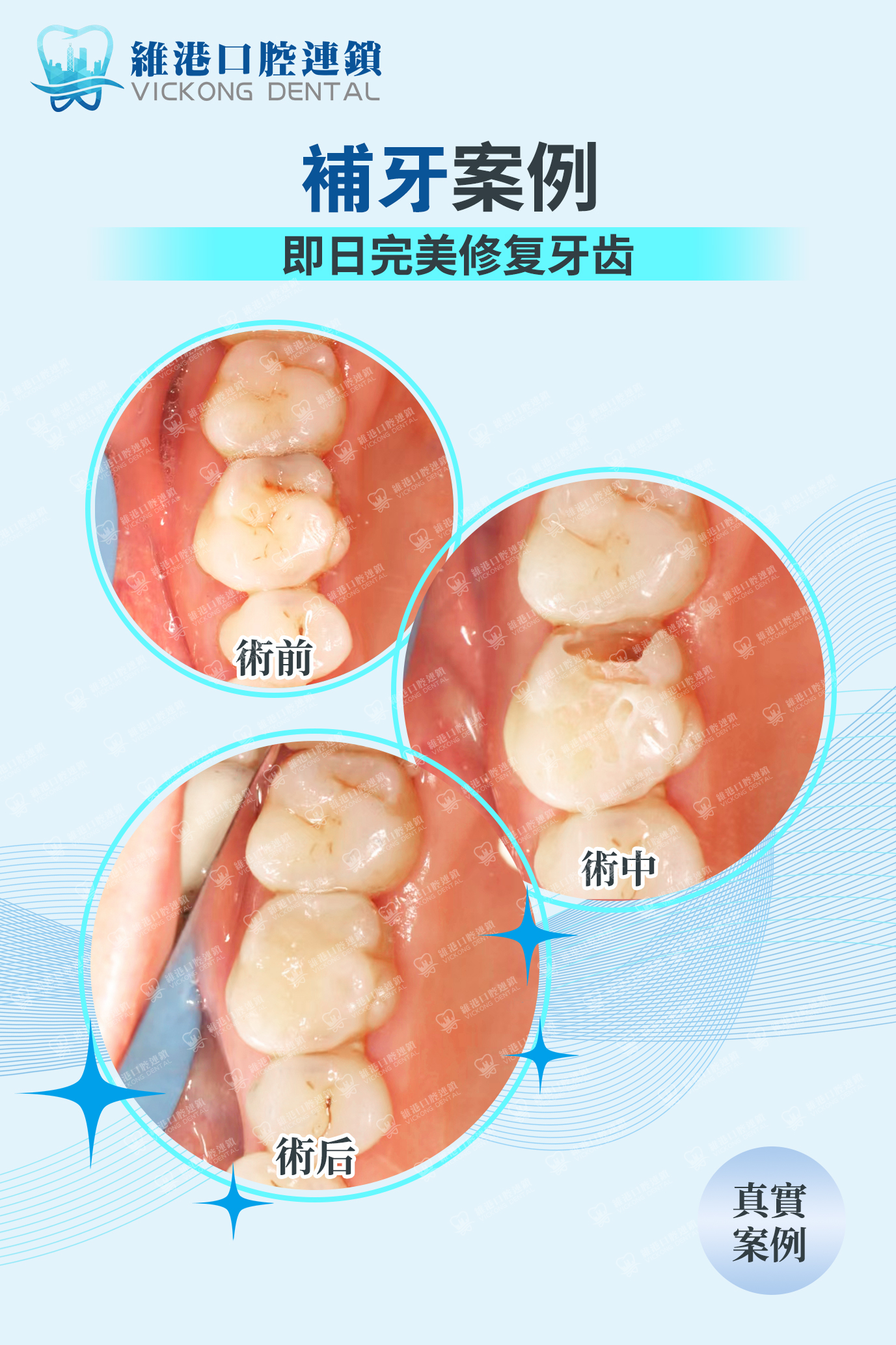 維港口腔補牙真實案例