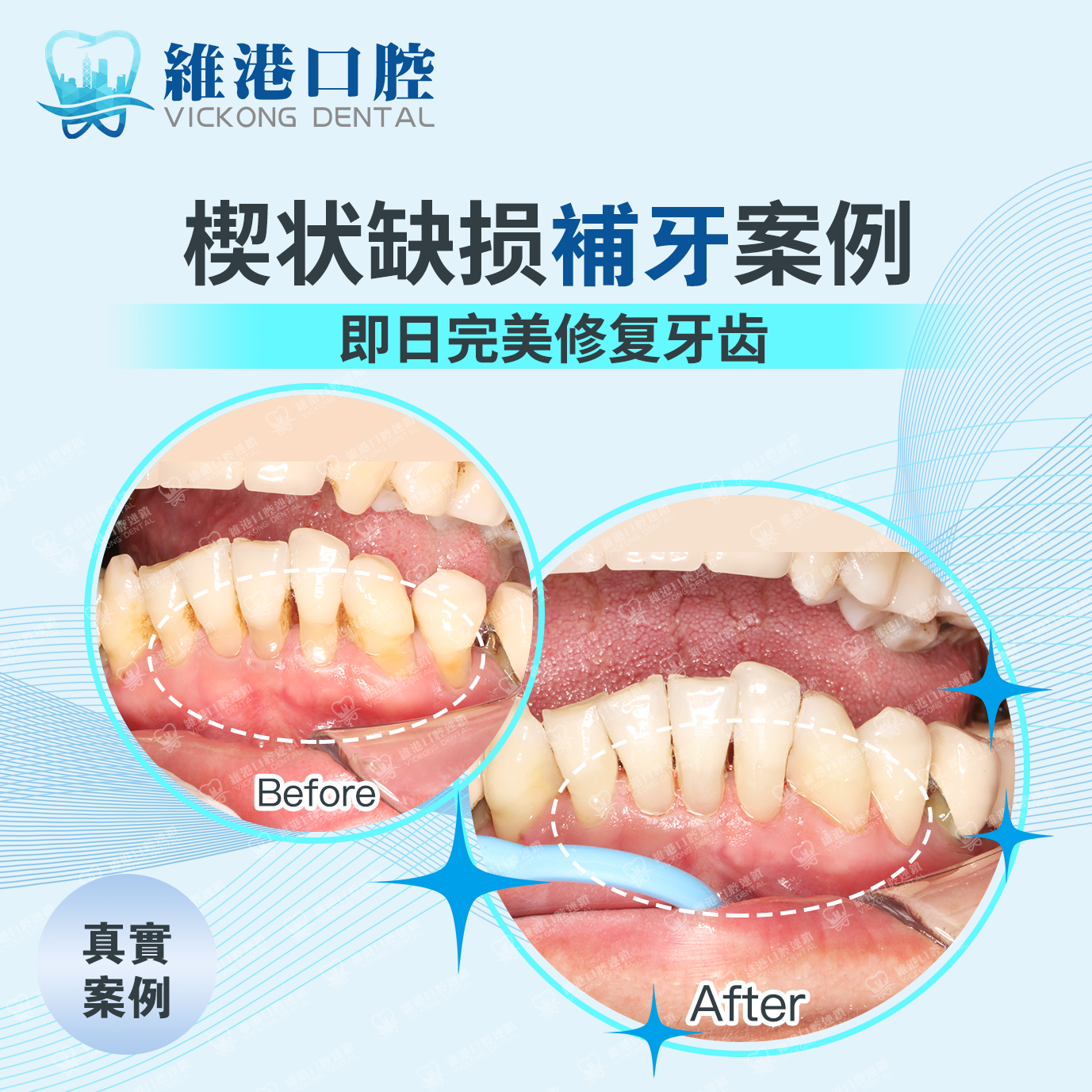維港口腔補牙案例