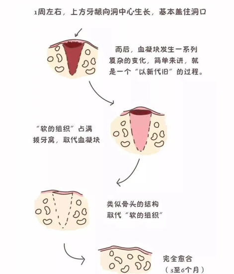 拔牙後傷口恢復過程