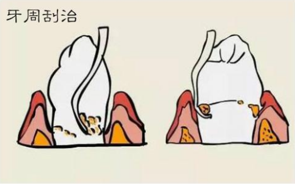 牙周刮治