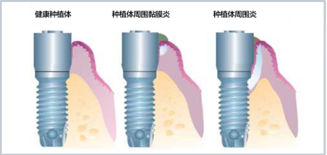 種植體周圍病