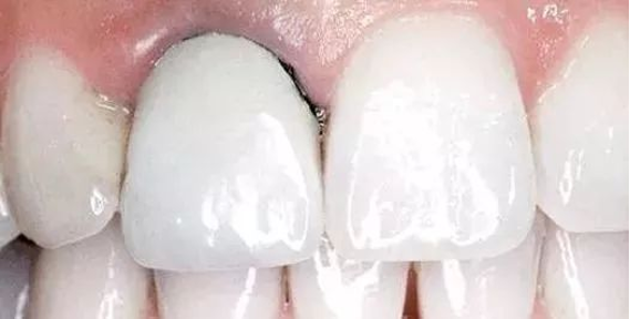 烤瓷牙出現黑線