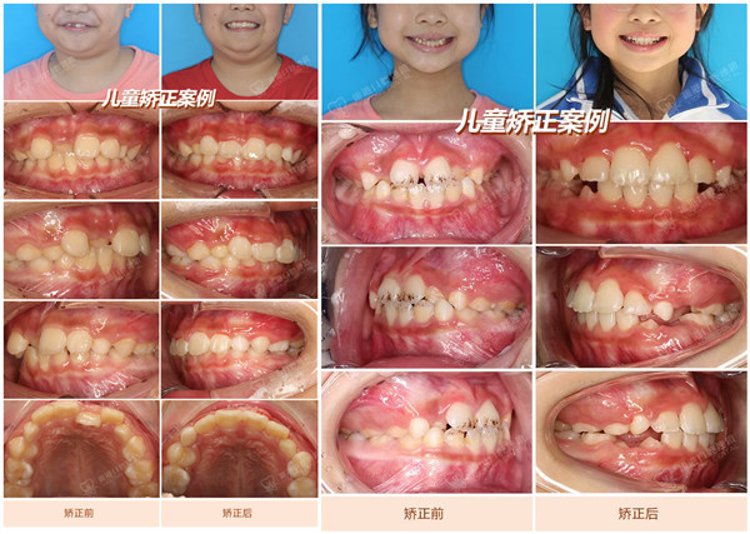 維港口腔兒童矯正案例