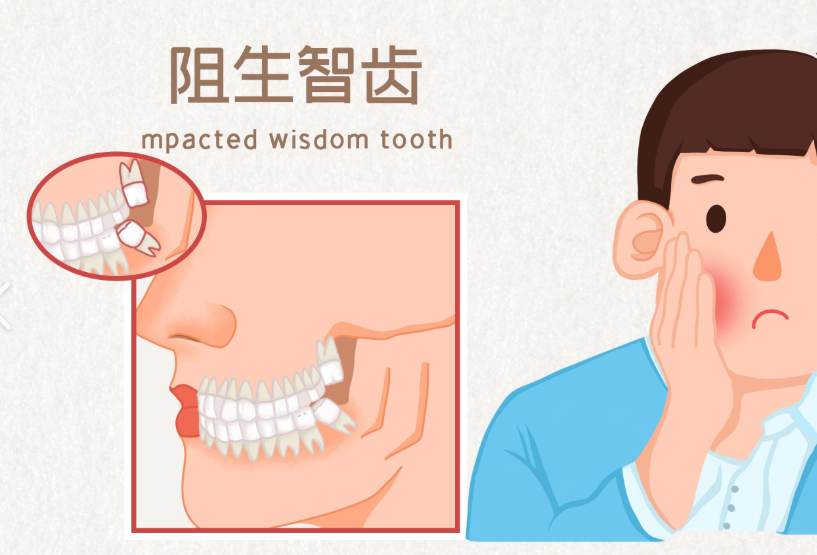 智齒清潔