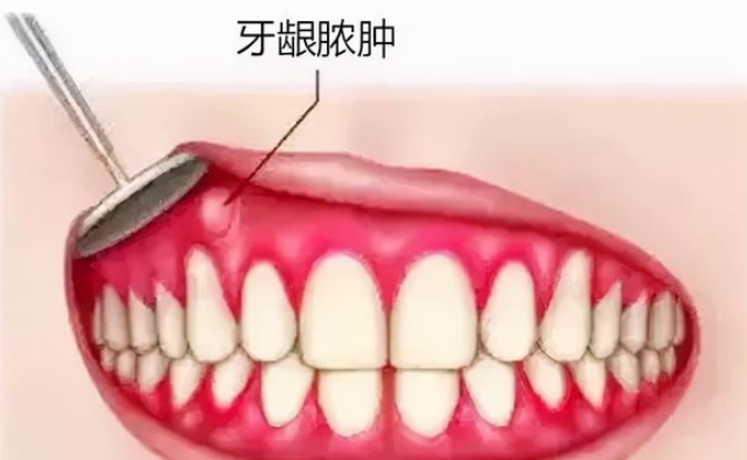 牙齦膿腫