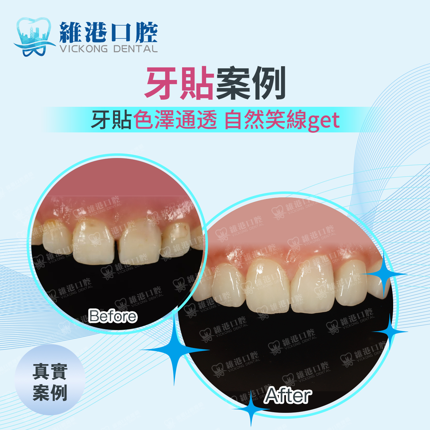 牙貼案例