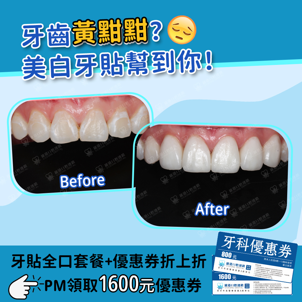 維港口腔做贴面