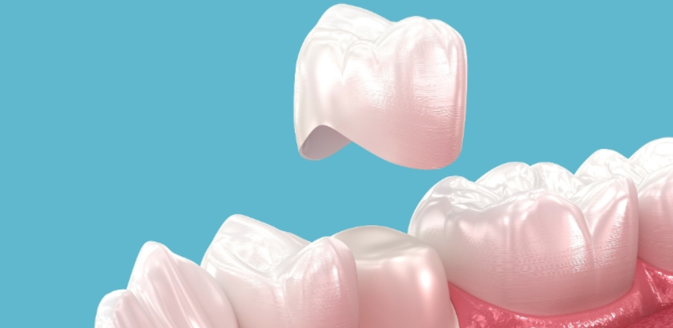 維港口腔做瓷牙套 維港口腔做瓷牙套